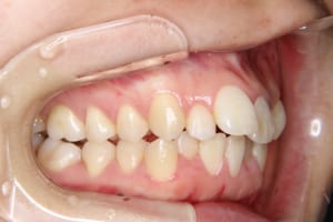 前歯部の叢生、上顎前突